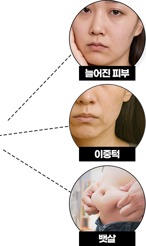 늘어진 피부, 이중턱, 뱃살